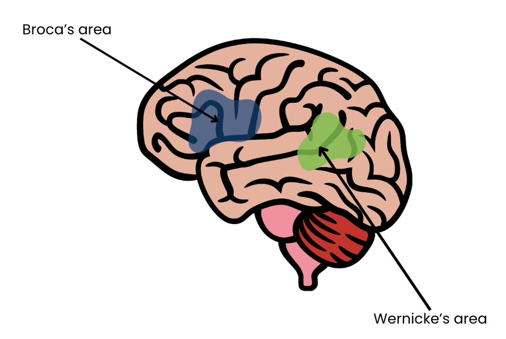 affected areas of aphasia brain
